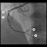 Coronary angiogram Coronary angiogram