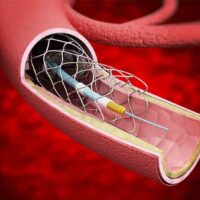 Percutaneous coronary intervention (STENT)